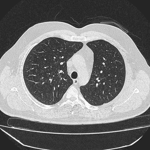 File:Bronchial atresia (Radiopaedia 58271-65417 Axial lung window 15).jpg