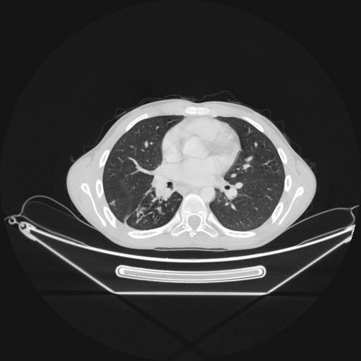 Bronchial carcinoid tumor (Radiopaedia 57187-64090 Axial lung window 41).jpg