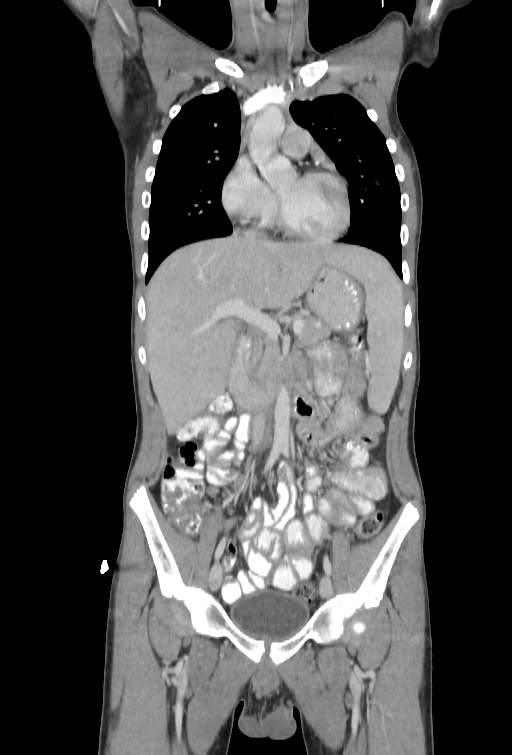 Bronchial carcinoid tumor (Radiopaedia 57187-64090 B 28).jpg