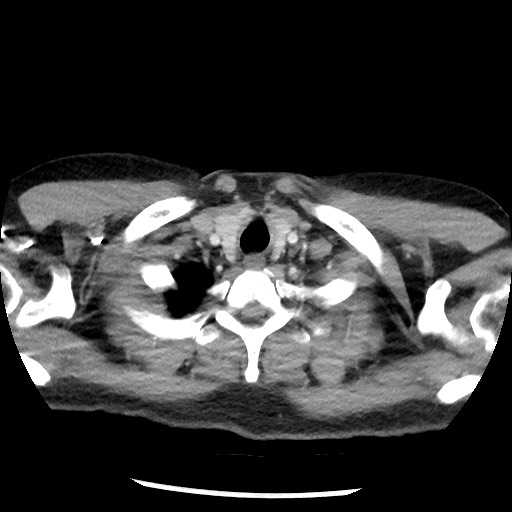 Bronchial carcinoid tumor (Radiopaedia 67377-76764 A 7).jpg
