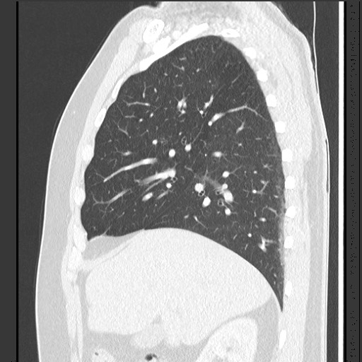 Bronchial carcinoid tumor (Radiopaedia 67377-76764 Sagittal lung window 22).jpg