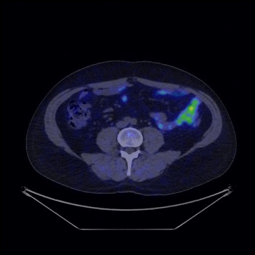 Bronchial carcinoid tumor (Radiopaedia 67377-76765 68Ga-DOTATATE PET-CT 57).jpg