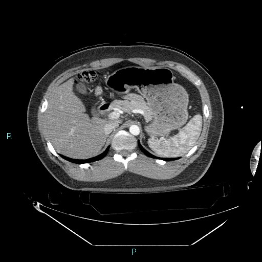 File:Bronchial carcinoid tumor (Radiopaedia 78272-90870 B 122).jpg