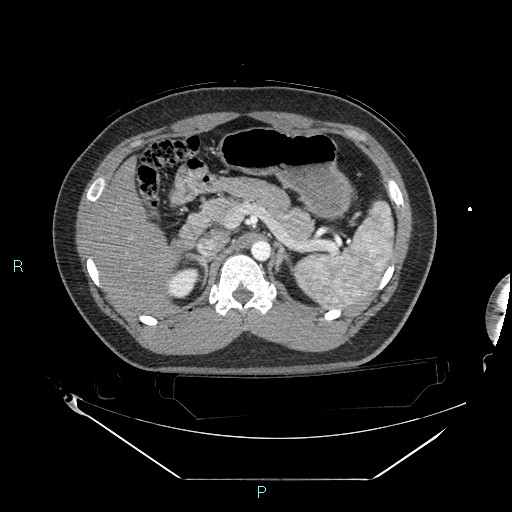 Bronchial carcinoid tumor (Radiopaedia 78272-90870 B 128).jpg
