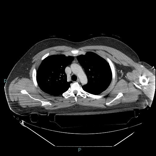 Bronchial carcinoid tumor (Radiopaedia 78272-90870 C 40).jpg