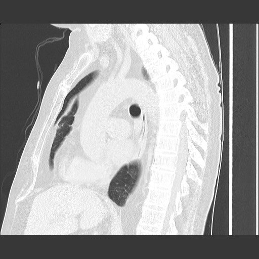 Bronchial stenosis - lung transplant (Radiopaedia 73133-83848 Sagittal lung window 36).jpg