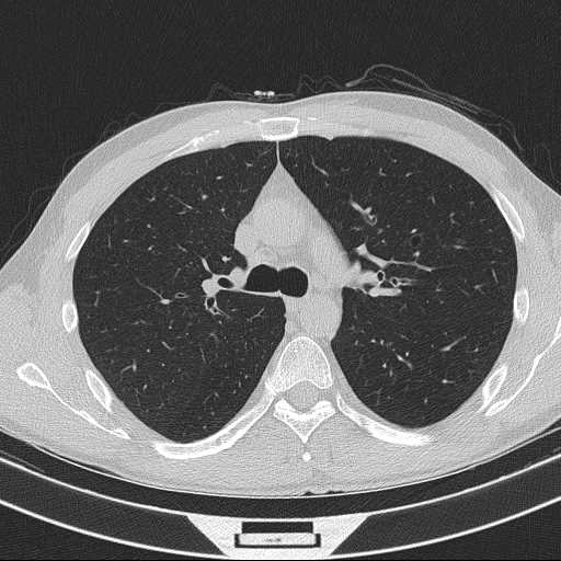 Bronchocele (Radiopaedia 60676-68429 Axial lung window 26).jpg