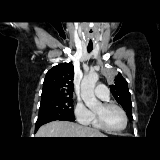 Bronchogenic carcinoma (Radiopaedia 73497-84262 C 53).jpg