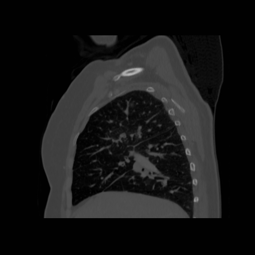 Bronchogenic carcinoma (Radiopaedia 73497-84262 Sagittal bone window 55).jpg