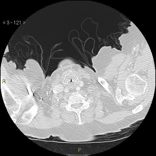 Bronchogenic carcinoma as an incidental finding (Radiopaedia 16453-16130 Axial lung window 121).jpg