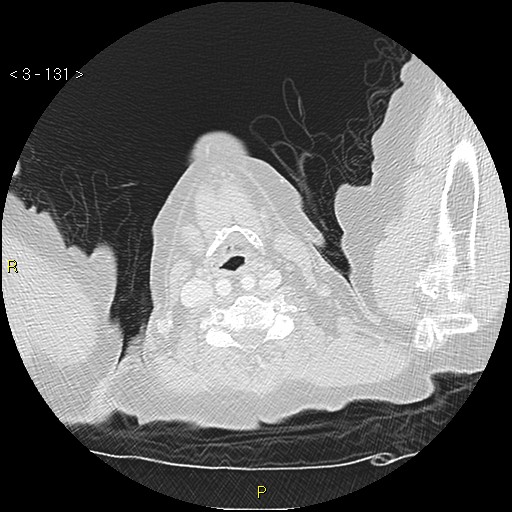 Bronchogenic carcinoma as an incidental finding (Radiopaedia 16453-16130 Axial lung window 131).jpg