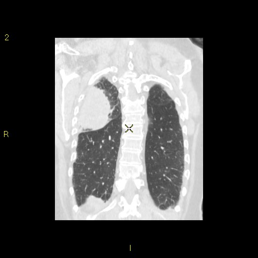 File:Bronchogenic carcinoma as an incidental finding (Radiopaedia 16453-16130 Coronal lung window 39).jpg