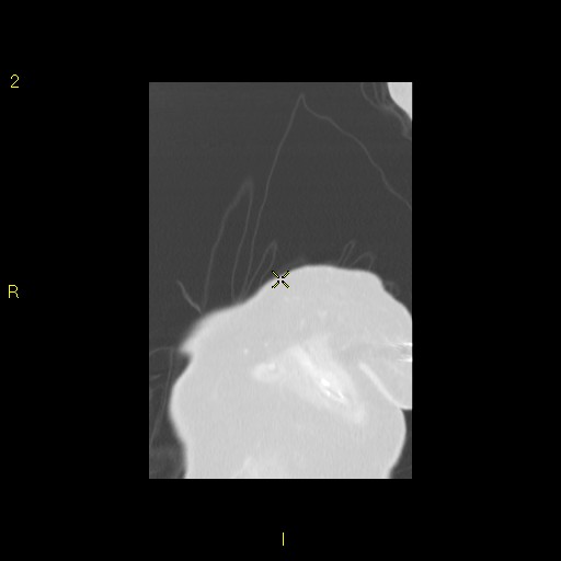 File:Bronchogenic carcinoma as an incidental finding (Radiopaedia 16453-16130 Coronal lung window 7).jpg