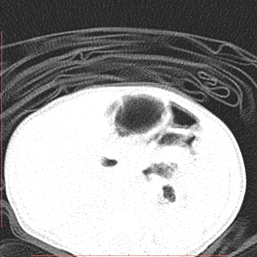 File:Bronchogenic cyst (Radiopaedia 78599-91409 Axial lung window 170).jpg