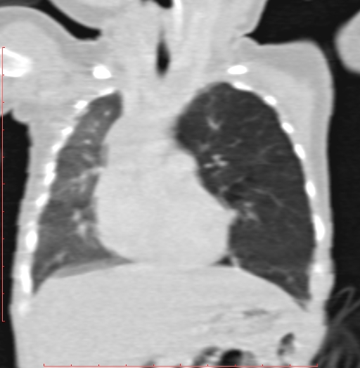 Bronchogenic cyst (Radiopaedia 78599-91409 Coronal lung window 95).jpg