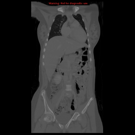 File:Brown tumor (Radiopaedia 12318-12596 D 27).jpg