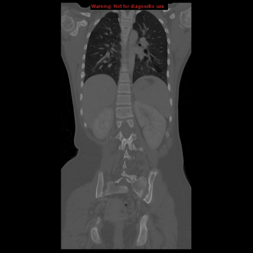 File:Brown tumor (Radiopaedia 12318-12596 D 45).jpg