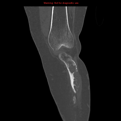 File:Brown tumors (Radiopaedia 9666-10291 Coronal bone window 6).jpg