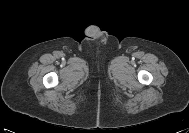 Brown tumors compressing the spinal cord (Radiopaedia 68442-77988 E 145).jpg