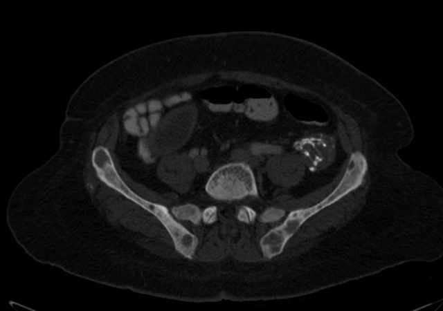 Brown tumors compressing the spinal cord (Radiopaedia 68442-77988 G 89).jpg