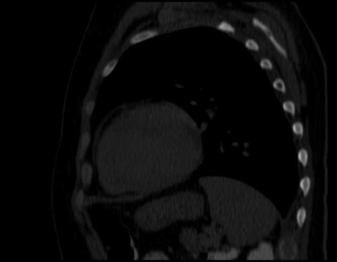 Brown tumors compressing the spinal cord (Radiopaedia 68442-77988 Sagittal bone window 42).jpg