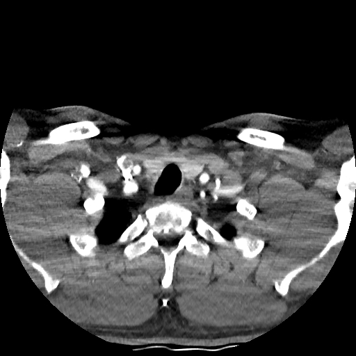 Buccal fat pad arteriovenous malformation (Radiopaedia 70936-81144 D 43).jpg