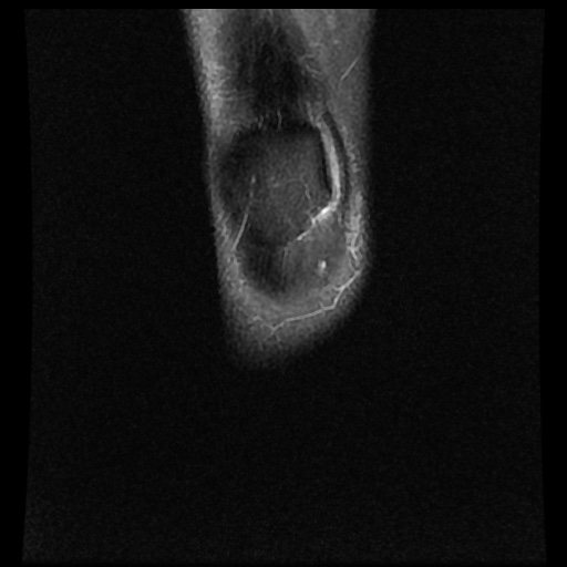 File:Bucket handle meniscus tear (Radiopaedia 56916-63751 Coronal PD fat sat 1).jpg