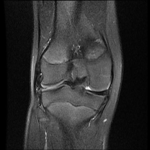 File:Bucket handle tear - lateral meniscus (Radiopaedia 72124-82634 Coronal PD fat sat 11).jpg
