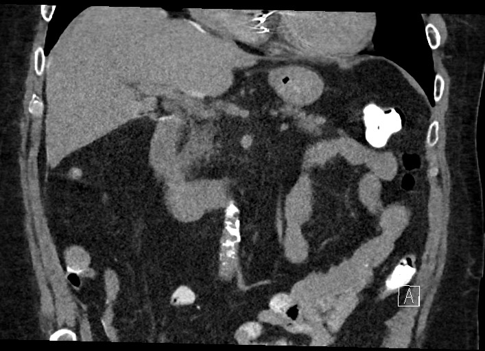 Buried bumper syndrome - gastrostomy tube (Radiopaedia 63843-72577 Coronal Inject 64).jpg
