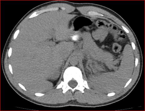 File:Burned-out testicular choriocarcinoma (Radiopaedia 32822-34040 Axial non-contrast 1).jpg