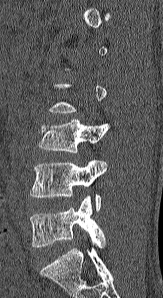 Burst fracture (Radiopaedia 53373-59357 Sagittal bone window 59).jpg