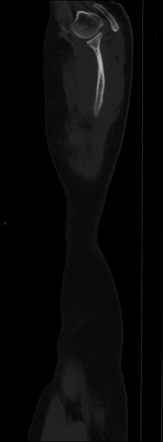 Burst fracture (Radiopaedia 83168-97542 Sagittal bone window 117).jpg