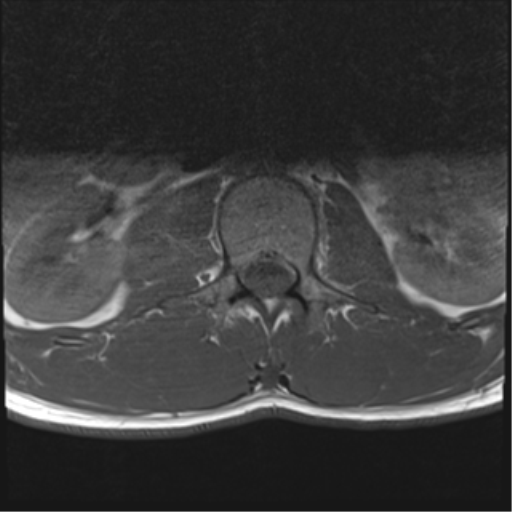 File:Burst fracture - T12 with conus compression (Radiopaedia 56825-63646 Axial T1 7).png