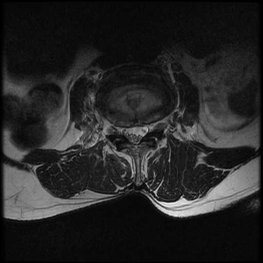 File:Burst fracture - lumbar spine (Radiopaedia 72877-83541 Axial T2 11).jpg
