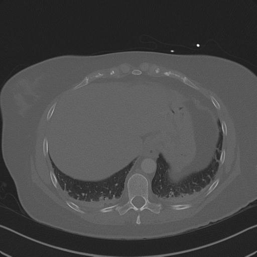 Burst fracture - thoracic spine (Radiopaedia 30238-30865 Axial bone window 73).jpg