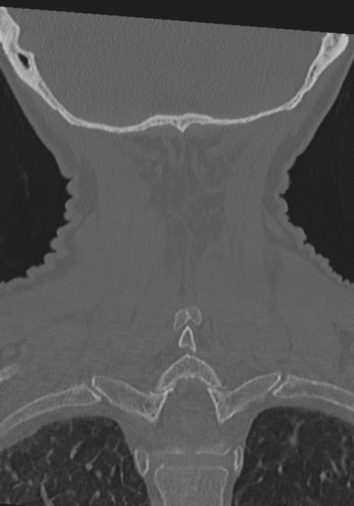 C2 fracture with vertebral artery dissection (Radiopaedia 37378-39199 Coronal bone window 45).png