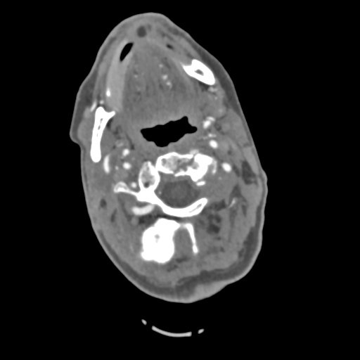 File:C2 fracture with vertebral artery dissection (Radiopaedia 37378-39200 A 170).png