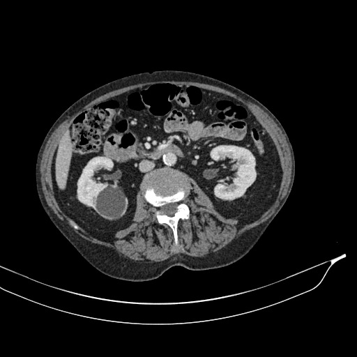 Calcified adrenal glands and Spigelian hernia (Radiopaedia 49741-54988 A 98).jpg