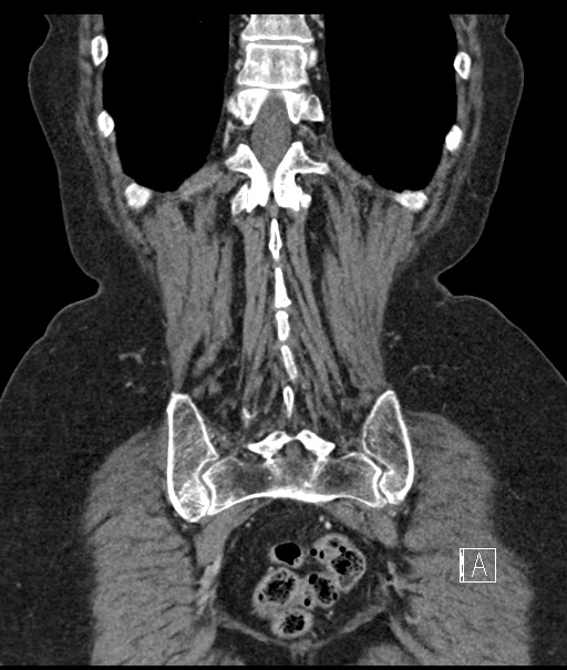 Calcified adrenal glands and Spigelian hernia (Radiopaedia 49741-54988 B 99).jpg