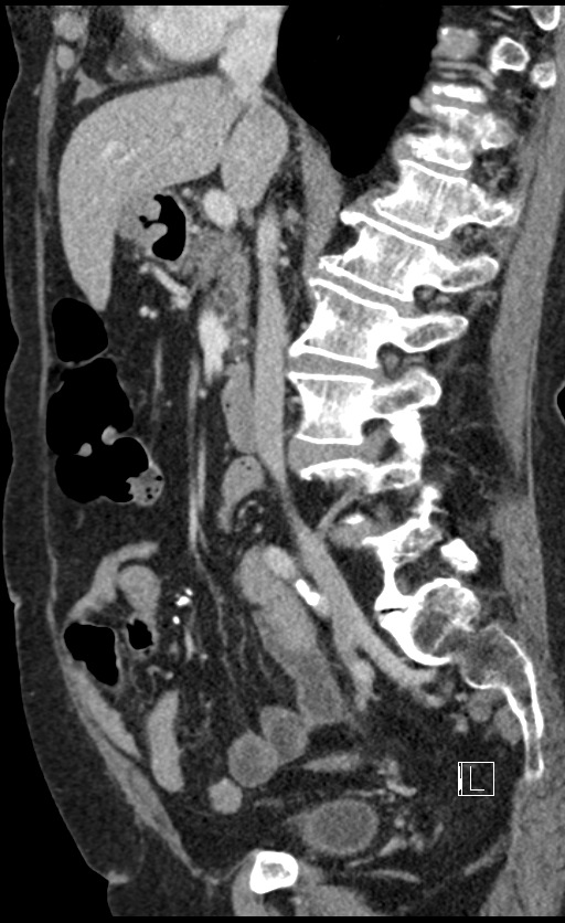 Calcified adrenal glands and Spigelian hernia (Radiopaedia 49741-54988 C 93).jpg