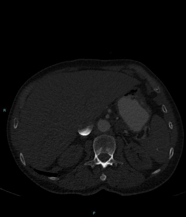 Calcified cerebral emboli from left ventricular thrombus (Radiopaedia 84420-99760 Axial bone window 85).jpg