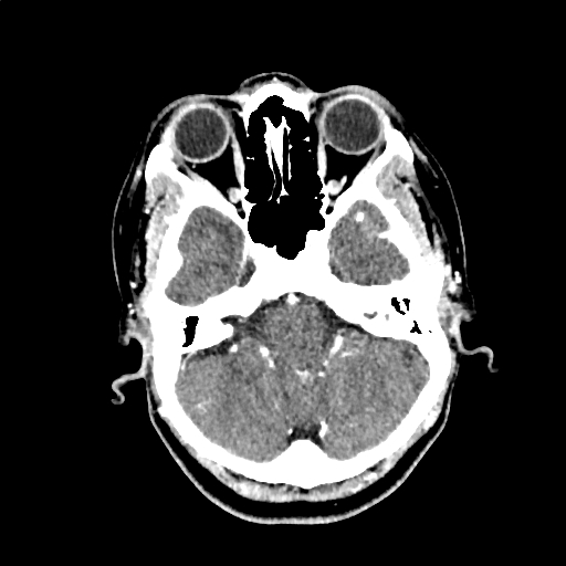 File:Calcified cerebral hydatid cyst (Radiopaedia 65603-74717 Axial with contrast 11).jpg