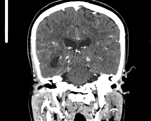 Calcified cerebral hydatid cyst (Radiopaedia 65603-74717 C 43).jpg