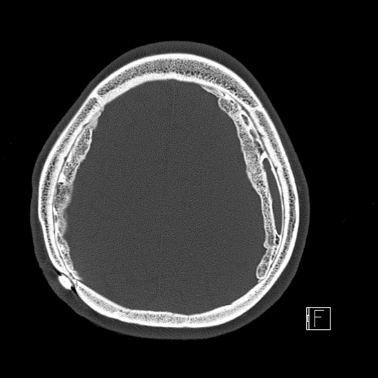 Calcified chronic subdural hematoma (Radiopaedia 77374-89492 Axial bone window 103).jpg