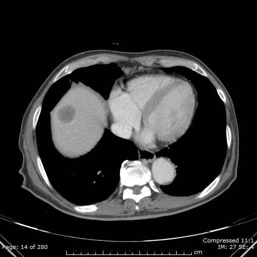 Calcified liver metastases (Radiopaedia 44699-48470 B 5).jpg