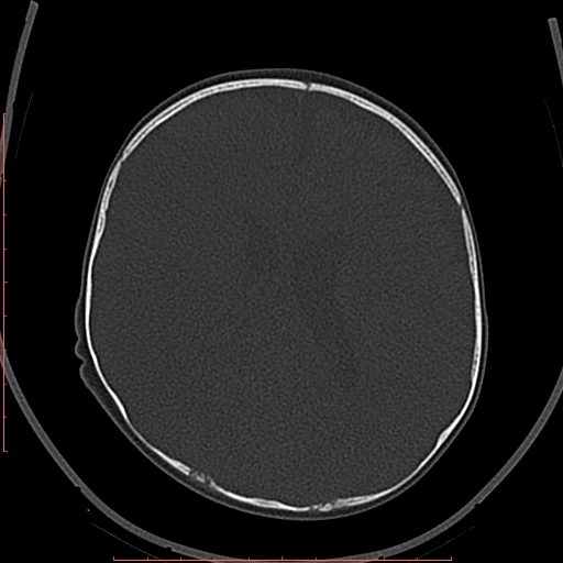Calcified middle cerebral artery embolism (Radiopaedia 78949-91860 Axial bone window 41).jpg