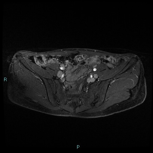 File:Canal of Nuck cyst (Radiopaedia 55074-61448 Axial T1 C+ fat sat 12).jpg