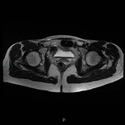 File:Canal of Nuck cyst (Radiopaedia 55074-61448 Axial T2 15).jpg