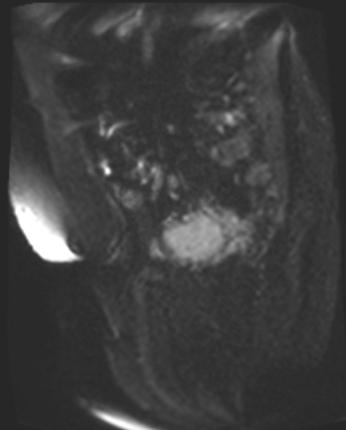 Cancer cervix - stage IIb (Radiopaedia 75411-86615 Sagittal DWI 42).jpg