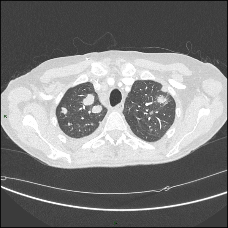 Cannonball metastases (Radiopaedia 82110-96150 Axial lung window 48).jpg